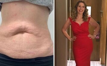 Woman who struggled with weight ‘all her life’ shed belly fat with ‘painless’ treatment